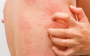 Ngứa dai dẳng, mệt mỏi không rõ nguyên nhân? Có thể bạn đang nhiễm sán chó mà không hề hay biết!